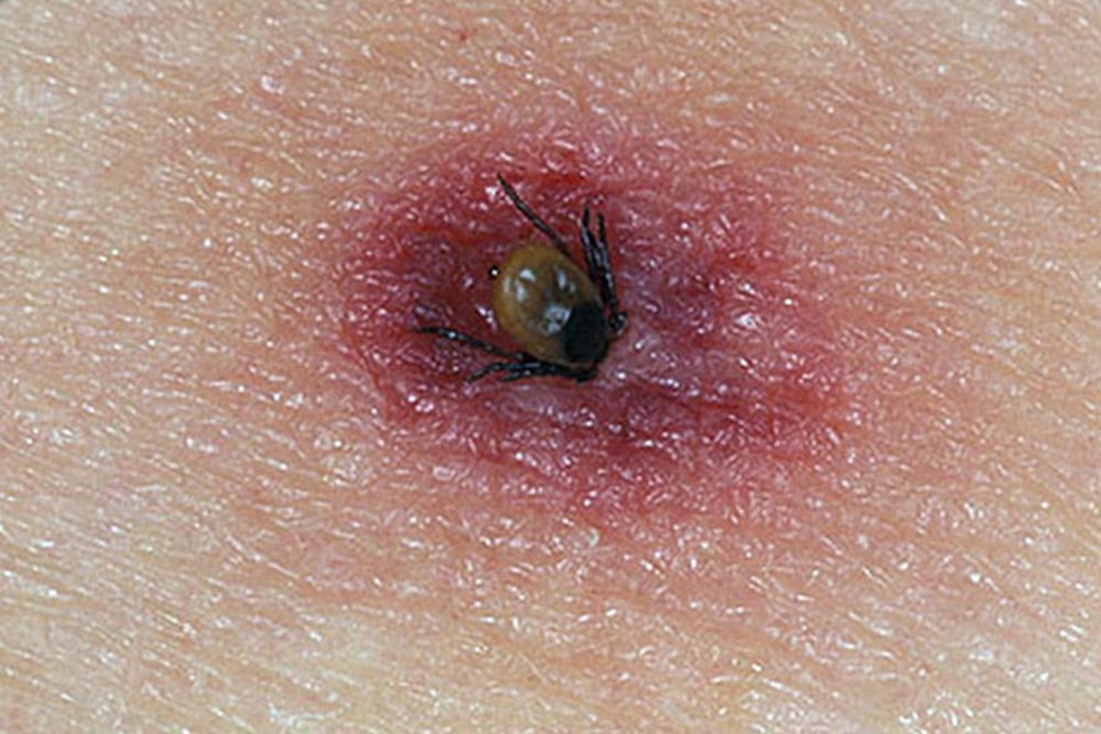 Tick bite infection