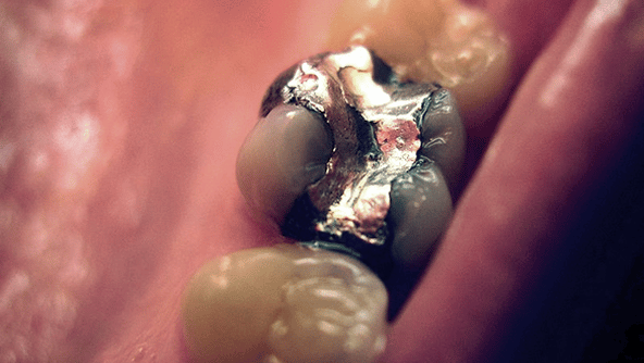 image of filling in molar showing amalgam