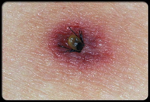 image of tick embeded in skin