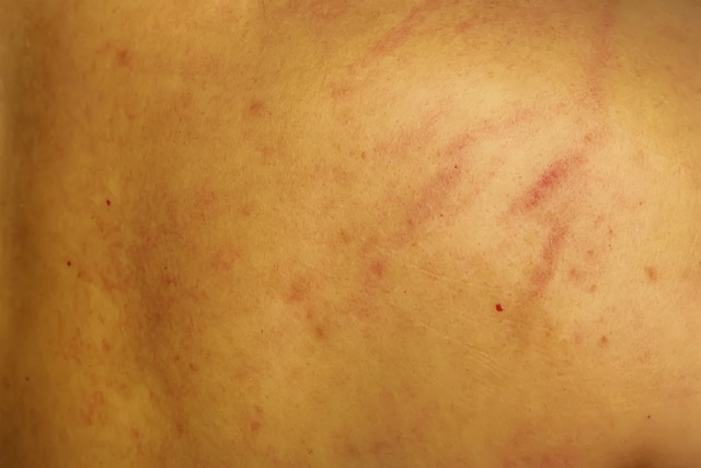 bartonella stretch marks